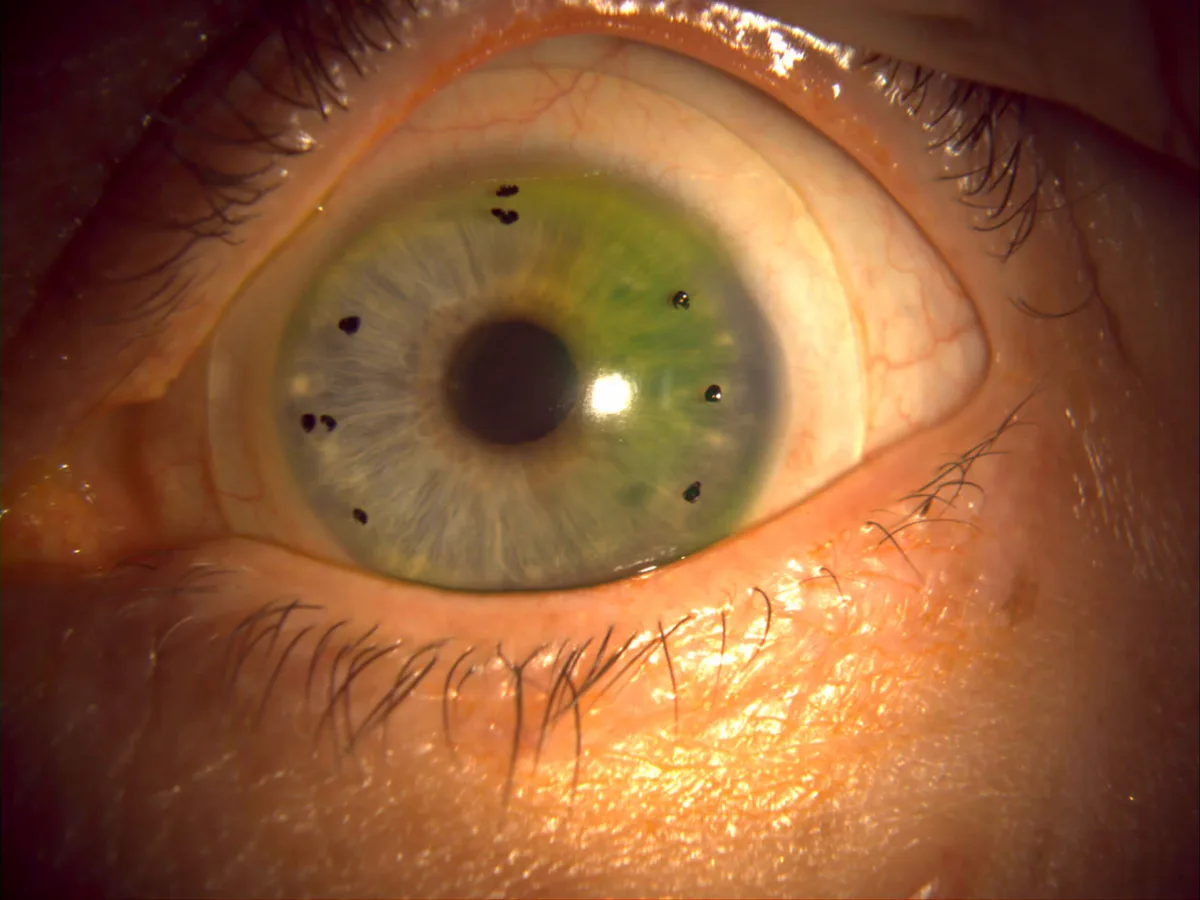 Are Ovitz Lenses Worth It? Cost, Results, and What to Expect