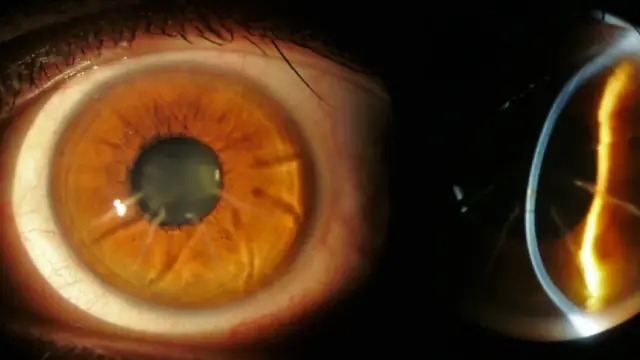 lens