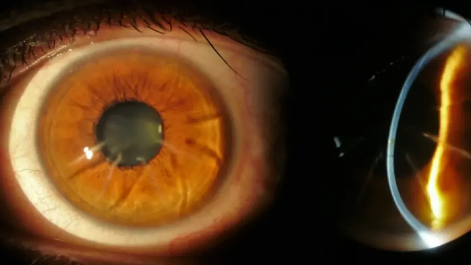 lens