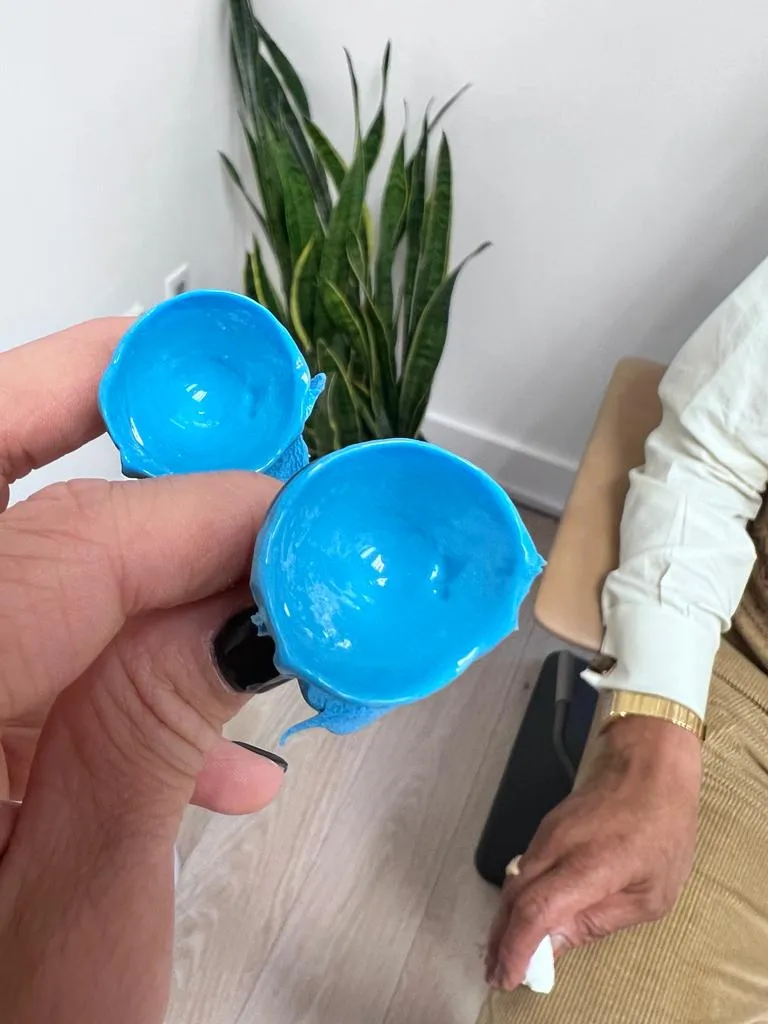 EyePrintPRO – Personalized Lenses for Challenging Corneal Conditions