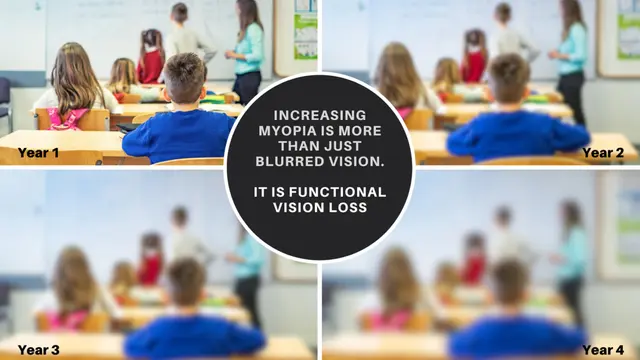 Risks of Untreated Childhood Myopia: Long-Term Effects & Prevention