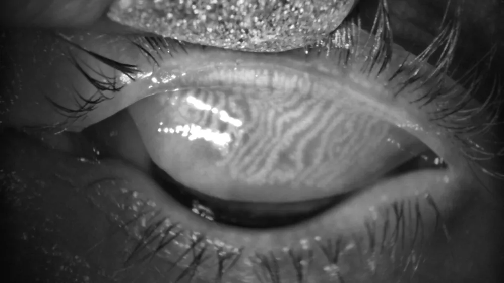 Can Keratoconus Cause Dry Eye? Symptoms, Treatments & Lenses