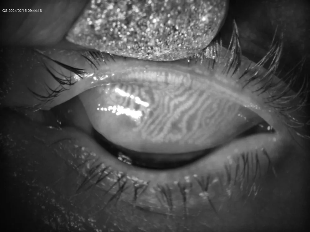 Can Keratoconus Cause Dry Eye? Symptoms, Treatments & Lenses