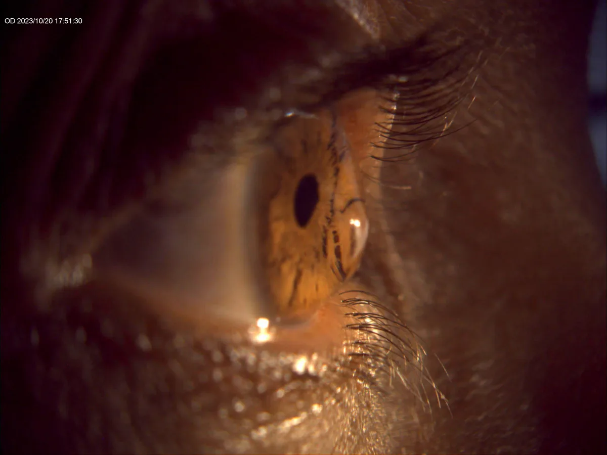 keratoconus