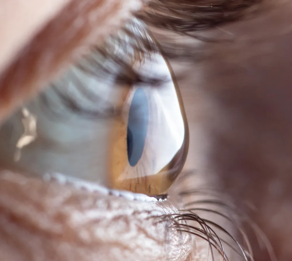 Why Eye Rubbing Is Dangerous for Keratoconus Patients