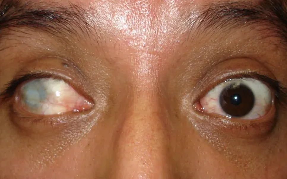Before prosthetic contact lens fitting showing iris irregularity - Case 1