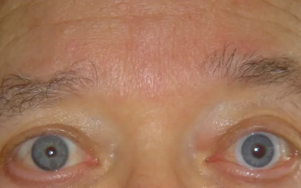 After prosthetic contact lens fitting with camouflaged scar and color match - Case 2