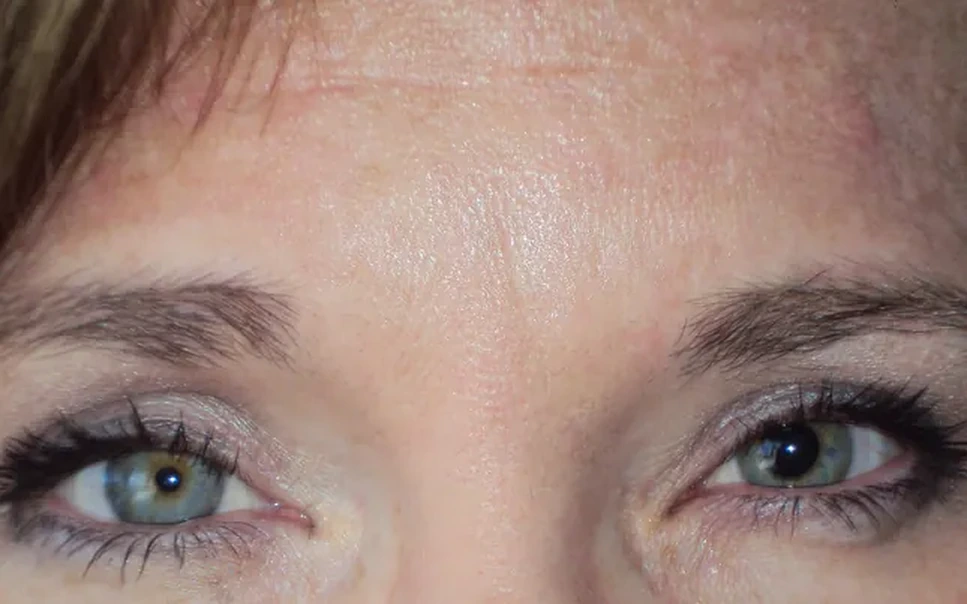 Before prosthetic contact lens fitting showing ocular trauma disfigurement - Case 4