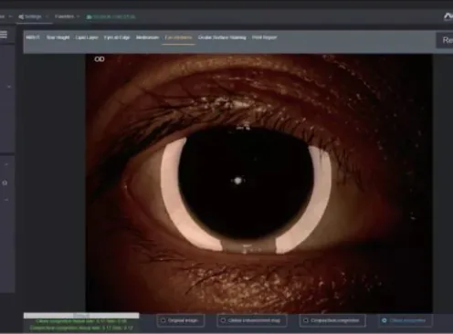 Anterior segment ocular surface inflammation grading