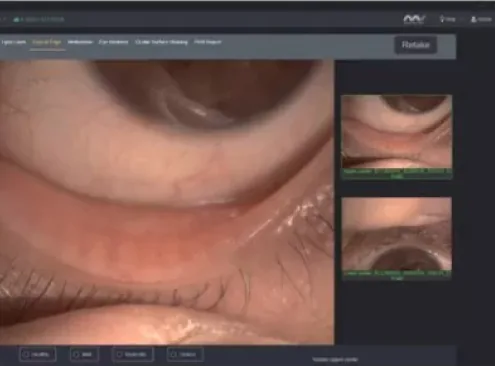High-magnification eyelid margin and lid wiper epitheliopathy assessment