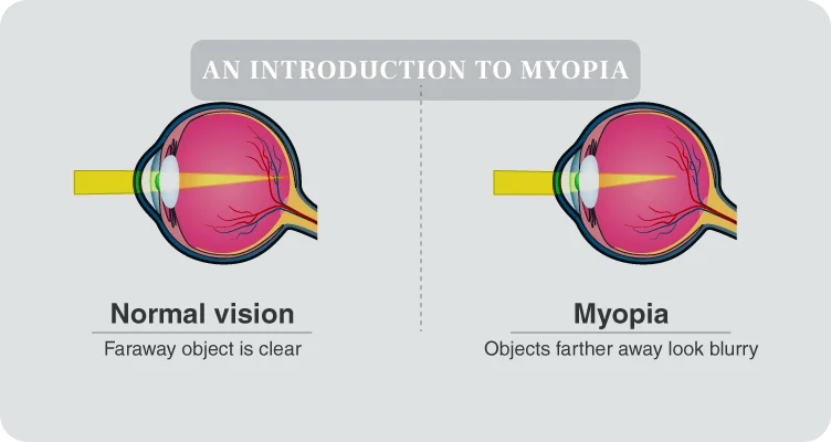 MiSight myopia management mechanism video preview