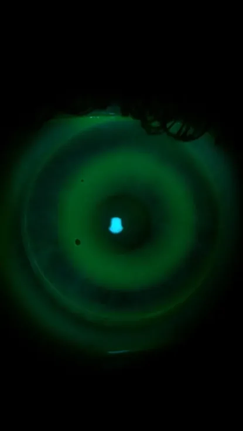 Orthokeratology overnight corneal reshaping lenses