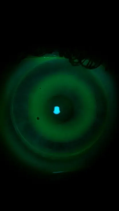 Orthokeratology night lenses