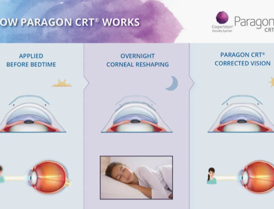 High-Definition Fluorescein Pattern Analysis for Orthokeratology