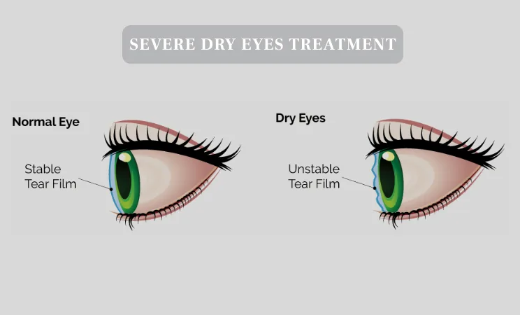 Severe dry eye disease video presentation by Dr. Ariel Cerenzie