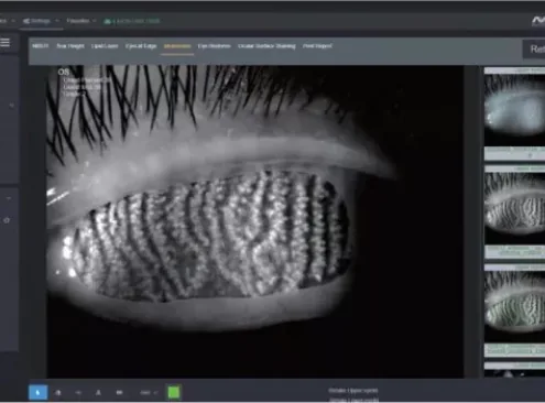Infrared meibography imaging demonstrating meibomian gland structure