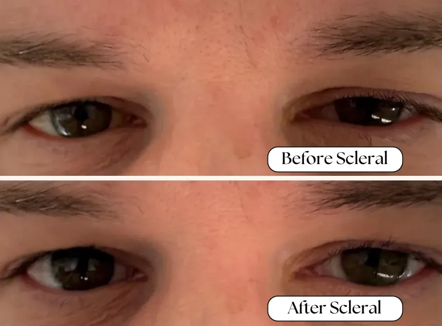 Before and after scleral contact lens comparison showing therapeutic relief