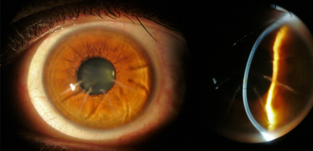 lens
